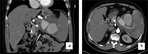 Contrast-enhanced CT scan (a—coronary view, b—axial view) of the abdomen revealed a large, partially thrombosed lesion measuring ~10 × 10 × 10 cm located at the hilum of the spleen. The lesion exhibited significant contrast enhancement in the arterial phase with peripheral thrombosis and displacement of the pancreatic tail.