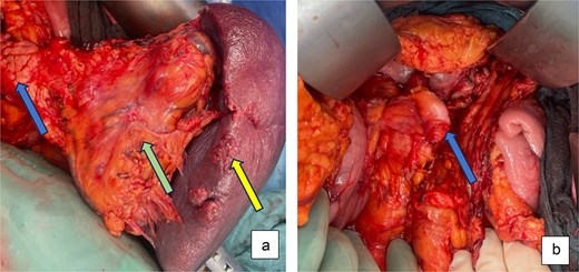 Intraoperative pictures: (a) After dissection and exposure of the giant SSA (green arrow) attached to spleen (yellow arrow) and distal pancreas (blue arrow) and (b) after distal pancreatosplenectomy with ligamentum teres patch on pancreatic stump (blue arrow).