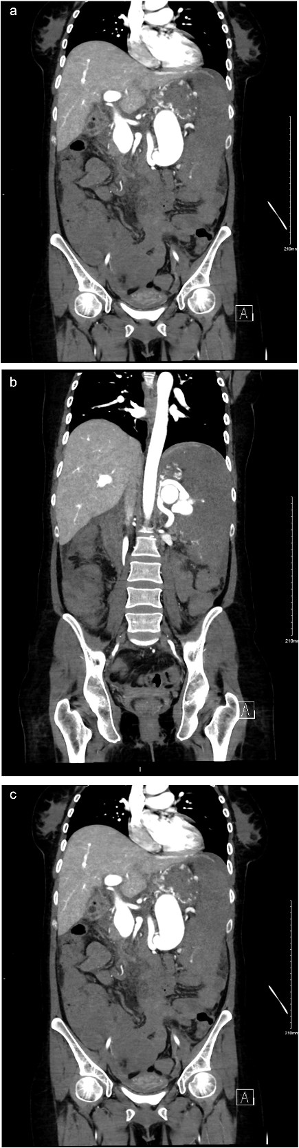 (a) Coronal view of enhanced CT of abdomen and pelvis showing dilated splenic vein lateral to the artery. (b) Coronal view of enhanced CT of abdomen and pelvis showing dilated splenic vein causing portal hypertension. (c) Coronal view of enhanced CT of abdomen and pelvis delayed imaging showing the AV fistula at the hilum.
