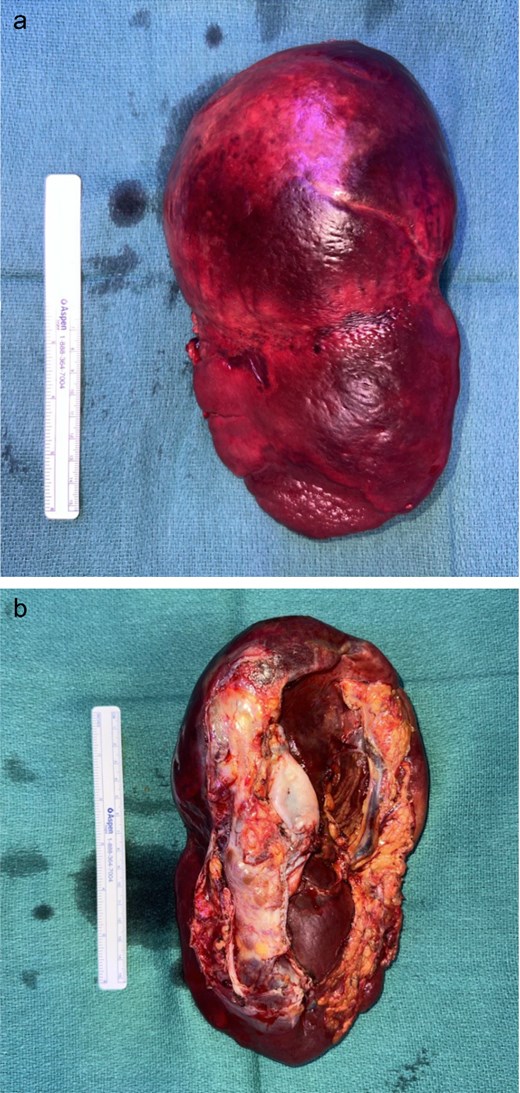 (a) Specimen spleen anterior side. (b) Specimen spleen.