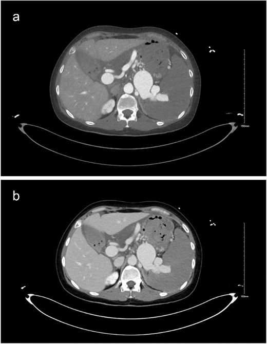(a and b) Delayed imaging CT of the abdomen and pelvis in axial view, showing the distended splenic vein and AV fistula at the hilum.
