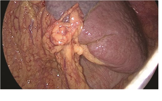 The spleen inferiorly, attached to it the mesentery and the transverse colon.