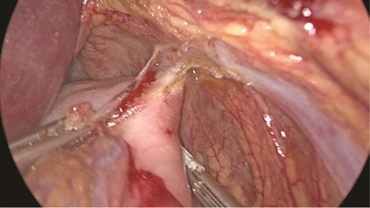 Stomach attached to the medial border of the spleen. Short gastric vessels.