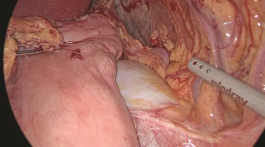Anterior portion of the splenic vein seen posterior to the stomach.