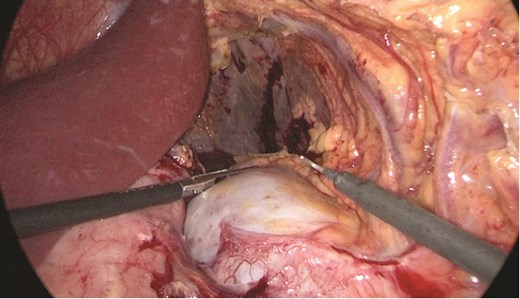 Anterior portion of the splenic vein seen posterior to the stomach.
