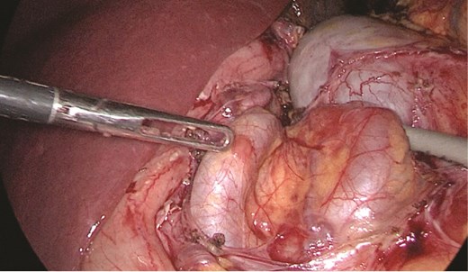 Tortuous splenic artery is seen medial to the splenic vein.