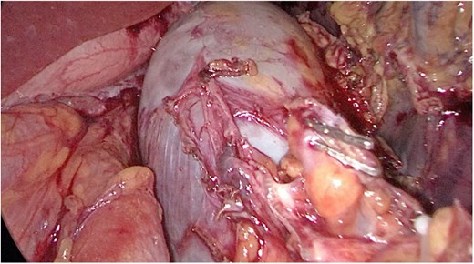 Splenic vein mobilized from the side. Clips seen on branches of the vein.