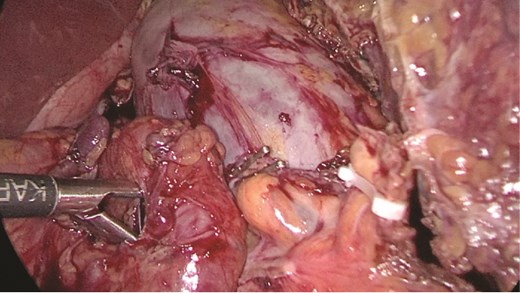 Mobilizing the splenic artery before ligation.