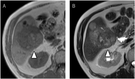 Magnetic resonance imaging showing multiple nodular lesions in liver S6/5 with low signal intensity on T1-weighted images (A), and mosaic-like high signal intensity on T2-weighted images (B).