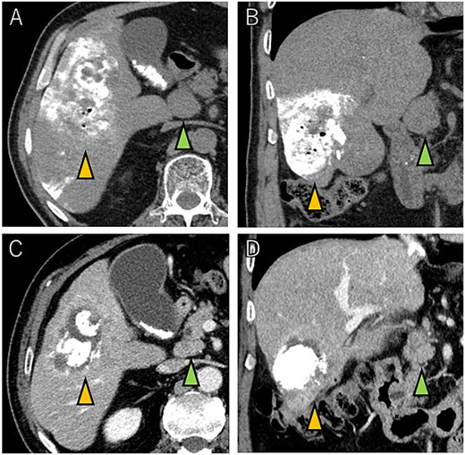 Tumor and enlarged lymph node in region 12b before ATZ + BV (A and B), and which got reduction after chemotherapy (C and D).