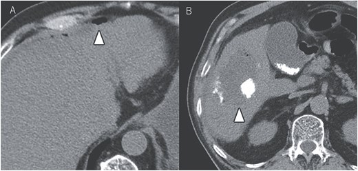 CT images showing tumor and enlarged lymph nodes in region 12b before ATZ + BV therapy (A and B). After chemotherapy, reduction of the tumor and lymph nodes is evident (C and D). Notably, no abscess formation was observed in the HCC or surrounding liver tissue, highlighting the direct communication between the tumor and the colon.