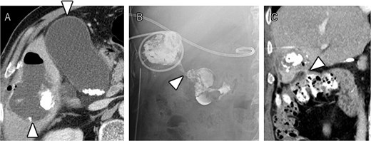 CT demonstrating a fluid collection with air inside the liver tumor, as well as enlargement and wall thickening of the gallbladder (A). Fistulography performing through the liver abscess drainage catheter revealed contrast filling in the colon (B). Subsequent CT scan showed that the liver tumor was adjacent to the catheter, with opacification of the colonic lumen (C).