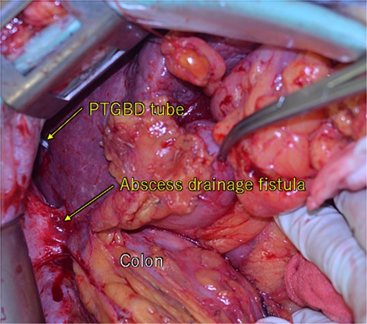 During the laparotomy, it was observed that the liver tumor, colon, and greater omentum were adhered together, forming a single mass. There were percutaneous transhepatic gallbladder drainage (PTGBD) tube and abscess drainage fistula. No intraperitoneal leakage of digestive fluids was observed.