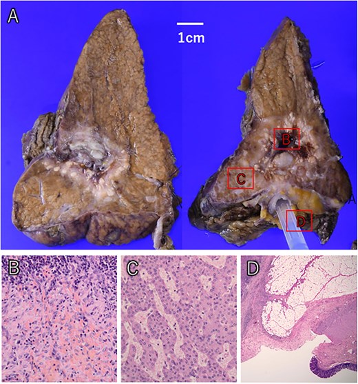 The liver tumor showed extensive macroscopic necrosis (A). Histologically, there was widespread necrosis with hemorrhage and inflammatory cell infiltration (B). Some areas exhibited proliferative cancer cells with disrupted trabecular structures, consistent with hepatocellular carcinoma (C). Colonic mucosa was identified within the fistula, confirming its formation between the liver tumor and colon (D).