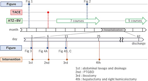 A time series diagram which shows the temporal relationship between figures and intervention, and, in particular, more detailed time series diagram of the hospitalization period.