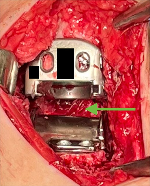 VersaWrap placed in the posterior ankle following capsular release.