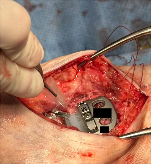 VersaWrap placed into medial ankle gutter.