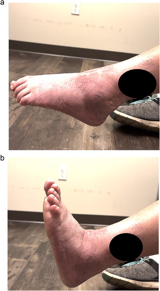 (a and b) Excellent range of motion is maintained post-operatively.