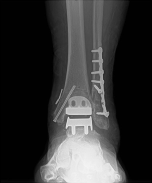 Post-operative radiograph without any sign of gutter impingement or ectopic bone formation.