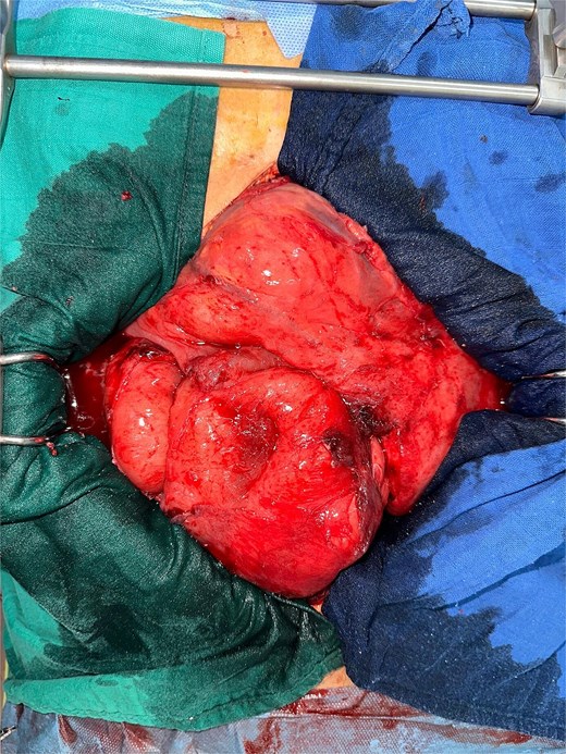 An omentum adherent to the underlying intestinal mass, and a conglomerate of agglutinated, obstructed small bowel loops with thickened, congested mesentery.