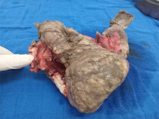 Intestinal mass.