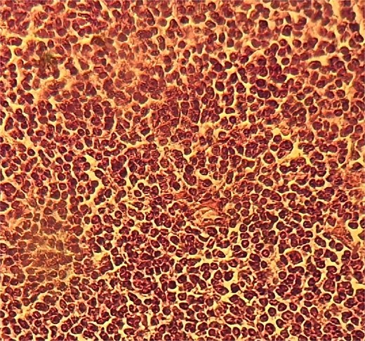 Dense lymphocytic infiltration.