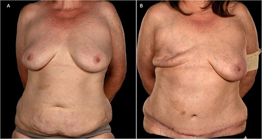 (A) Pre-operative photograph of patient 1 showing a smaller index right breast prior to mastectomy and adequate abdominal tissue for DIEP flap reconstruction. (B) Her 6-month post-operative shows a well-healed mastectomy scar following flap failure and primary closure. Please note the well-preserved inframammary fold.