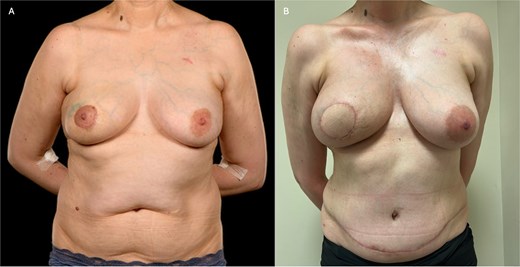 (A) Pre-operative photograph of patient 2 prior to right-sided skin-sparing mastectomy and DIEP flap reconstruction, showing the effects of periareolar lumpectomies. The margins were incomplete, necessitating a subsequent mastectomy. (B) Here she is shown 4 months post-operatively, and 3 weeks following completion of post-mastectomy radiotherapy. The flap has healed well with good volume and reasonable symmetry.