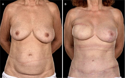 (A) Pre-operative photograph of patient 3 prior to bipedicled reconstruction for a right-sided breast cancer. The patient requested extensive skin resection (i.e. a simple mastectomy and axillary clearance), thereby necessitating wide cutaneous coverage which was to be achieved with a bipedicled DIEP flap in view of her thin body habitus and previous caesarean section scar. (B) Here she is shown 18 months postoperatively and12 months post-radiotherapy. She has reasonable symmetry with an improved abdominal appearance. Note that the contralateral breast was uplifted subsequent to the breast mound reconstruction.