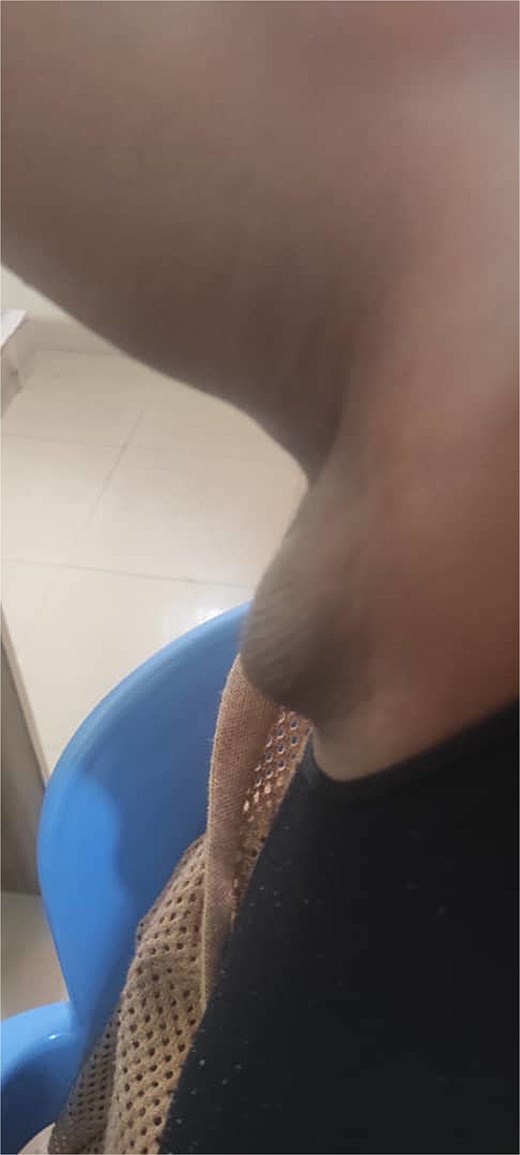 Axillary breast tissue at presentation.