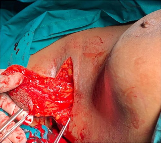 Intraoperative image of axillary breast tissue.