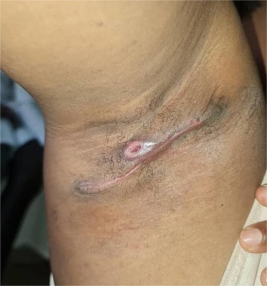 Postoperaive review during clinic visit after 2 weeks.