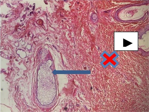 Axillary breast tissue ×40 magnification. Shows ectatic ducts containing secretions filled with foamy histiocytes (arrow), overlying skin epidermis (white arrow head) and interlobular stroma/dermis = red ‘X’ mark.