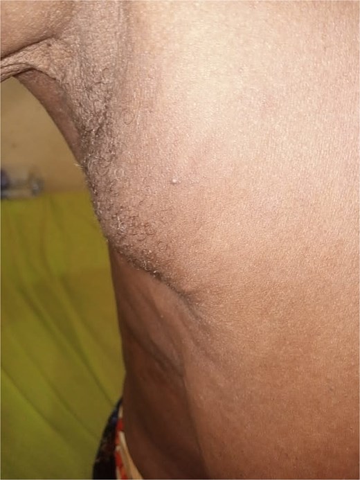 Axillary breast in an elderly woman.