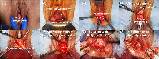 Presentation of the colpocleisis procedure. The figure illustrates the initial dissection of the anterior and posterior vaginal walls, the subsequent suturing using polyglactin 910, and the final closure of the vaginal canal.