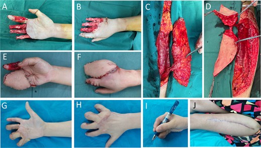Case 1. (A and B) Crush injury to the right hand. Following debridement, the phalanges were stabilized, and a piece of artificial dermis was applied to cover the palmar surface of the index finger. Despite this intervention, significant skin- and soft- tissue defects remained on fingers 2–5 of the right hand, with underlying bone and tendon exposed. (C and D) ALT perforator flap with a cutaneous perforator emanating from DB-LCFA, splitting of flap into two paddles was based on the bifurcation near the perforating point in skin. (E and F) Right hand immediately after flap coverage. (G–I) Aesthetical and functional outcome of hand 3 months after finger-splitting surgery. (J) Donor site on thigh healed with a linear scar.