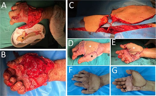 Case 2. (A) The dorsal-side defect of the right hand. The thumb was involved, and to address this, a neovascular flap from the great toe was prepared (black asterisk), ready to cover. (B) The palmar-side defect. The thumb was constructed with the toe-to-thumb flap transfer. (C) A double-paddle ALT perforator flap. (D and E) Immediately following soft-tissue reconstruction, two white asterisks—one in D and another in E—denote the two skin paddles, while a black asterisk indicates the great toe neovascular wrap-around flap. (F and G) Outcome of the reconstructed 3-month postoperatively.