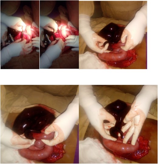 Intraoperative photo showing appendiceal knot around distal ileum.