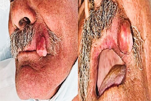 Preoperative clinical image showing a firm, non-tender nodule on the left upper lip.