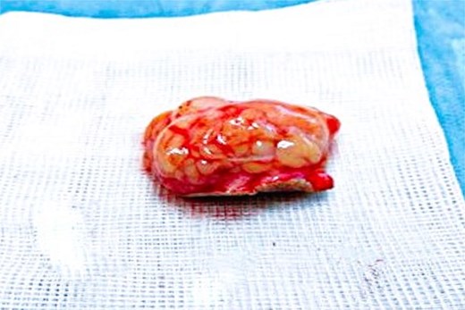 Macroscopic image showing the tumor.