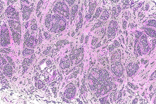 Histological section showing a well-circumscribed tumor composed of epithelial nests and tubules embedded in a myxoid and chondroid stroma (H&E, original magnification ×100).