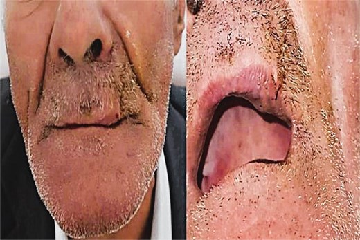 12-month postoperative result showing no recurrence and optimal aesthetic outcome.