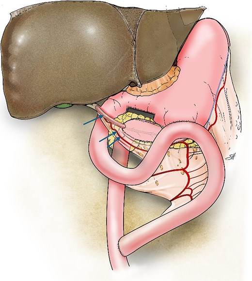Illustration of the triple bypass depicting reconstruction of the Roux-en-Y PJ, loop gastrojejunostomy, and the tubular gastric conduit (single arrow) created from the greater curvature of the stomach while maintaining the left gastroepiploic arcade (double arrows) to complete the end-to-side hepaticojejunostomy.