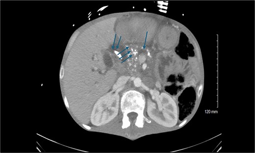 Preoperative computed tomography scan of the abdomen showing the calcified head of the pancreas (triple arrows), dilated pancreatic duct (single arrow), and dilated common bile duct (double arrows).