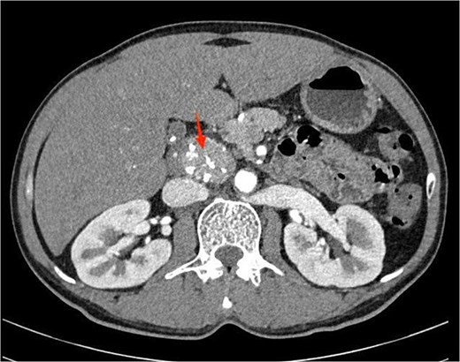 Contrast-enhanced abdominal computed tomography showing a well-defined, homogeneously enhancing retroperitoneal mass with punctate calcifications, located anterior to the aorta and posterior to the pancreatic head.