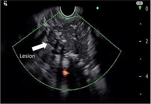 Endoscopic ultrasound image demonstrating a hypoechoic mass with defined margins, internal calcifications, and increased vascular flow.
