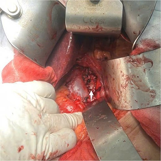 Intraoperative view of the retroperitoneal mass after complete surgical excision (indicated by arrow).