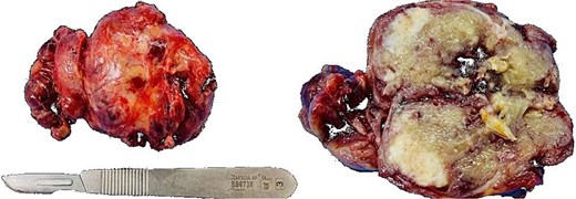 Gross specimen showing a 60 × 45 × 35 mm encapsulated, yellow–gray mass with scattered calcifications.