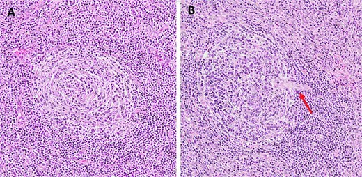 Example of hematoxylin and eosin histologic changes seen in unicentric hyaline vascular Castleman’s disease. (A) The atrophic germinal center surrounded by concentric layers of mantle zone lymphocytes forming the characteristic “onion-skin” appearance (original magnification ×200). (B) Blood vessels (arrow) penetrate the germinal center, creating a ``lollipop'' appearance for the follicle (original magnification ×200).