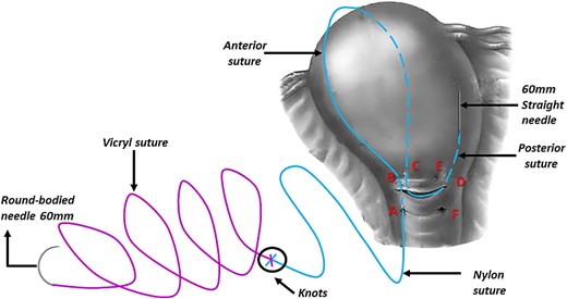 Illustrates how we penetrated the uterus with the straight needle that was pulling the Nylon and the Vicryl sutures (this figure is our own).